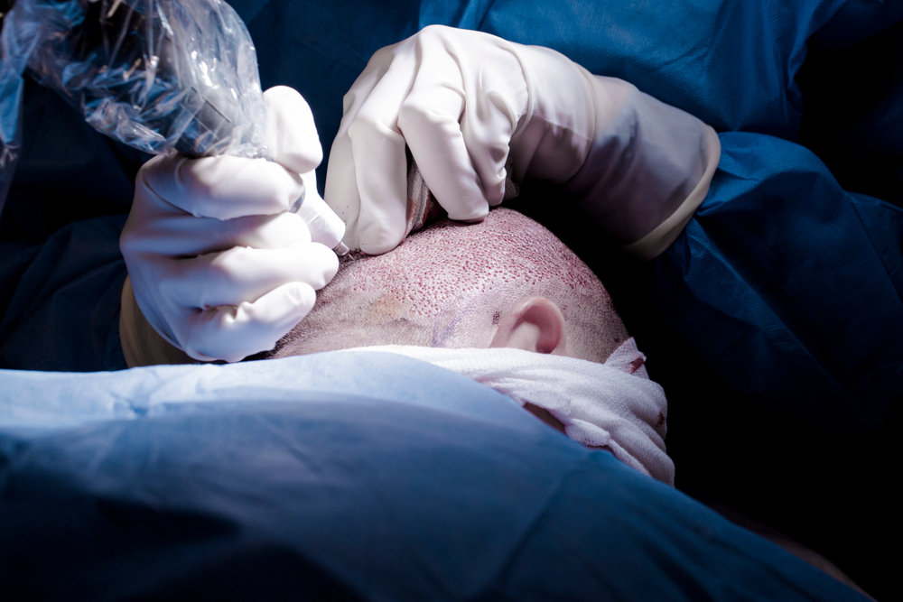 HAIR TRANSPLANT PROCEDURE