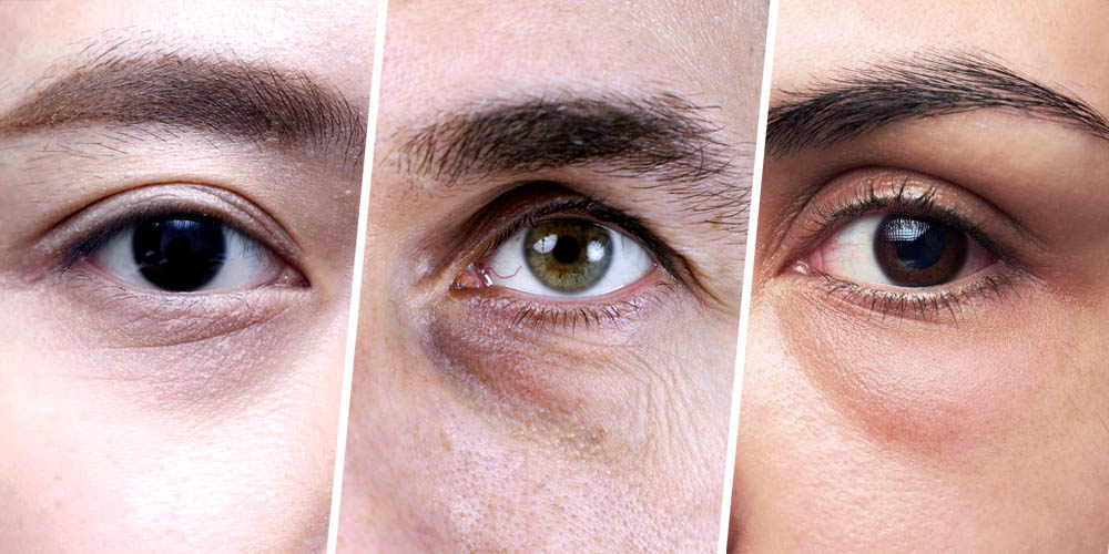 under eye conditions