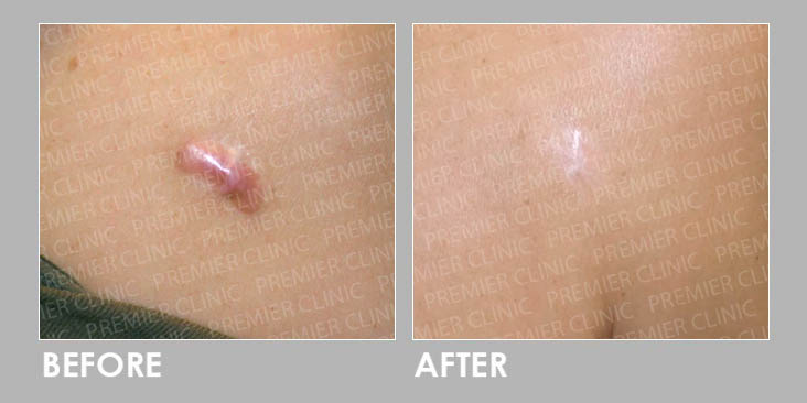 KELOID FREEZING THERAPY Before & After