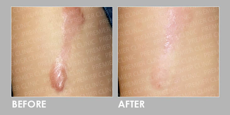 KELOID FREEZING THERAPY Before & After