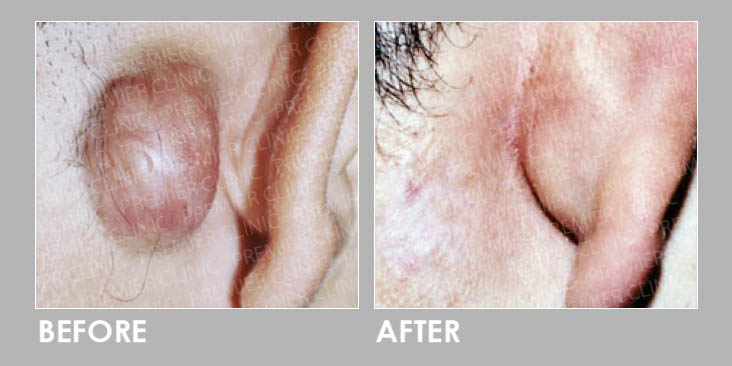 KELOID FREEZING THERAPY Before & After