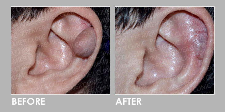 KELOID FREEZING THERAPY Before & After
