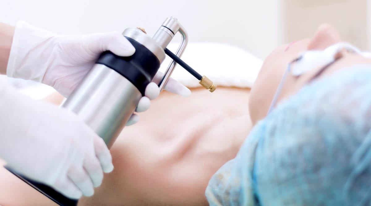 Keloid Freezing Therapy