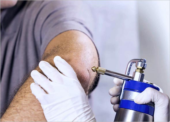cryogen for keloid