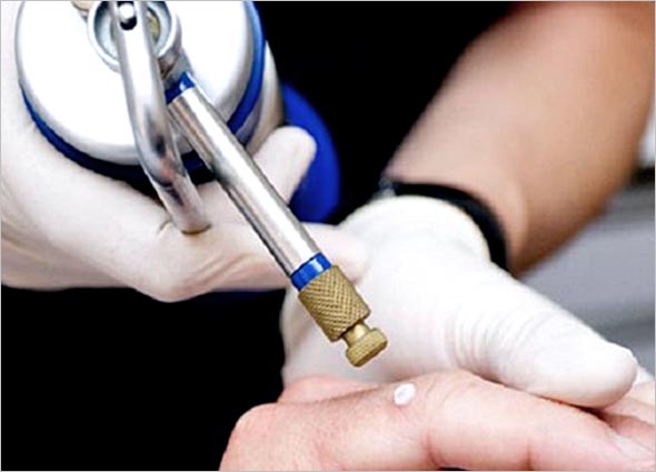 cryogen for keloid