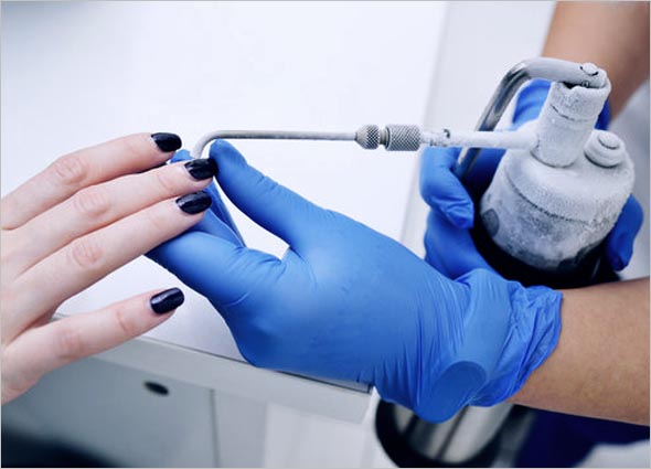 Keloid Freezing Therapy
