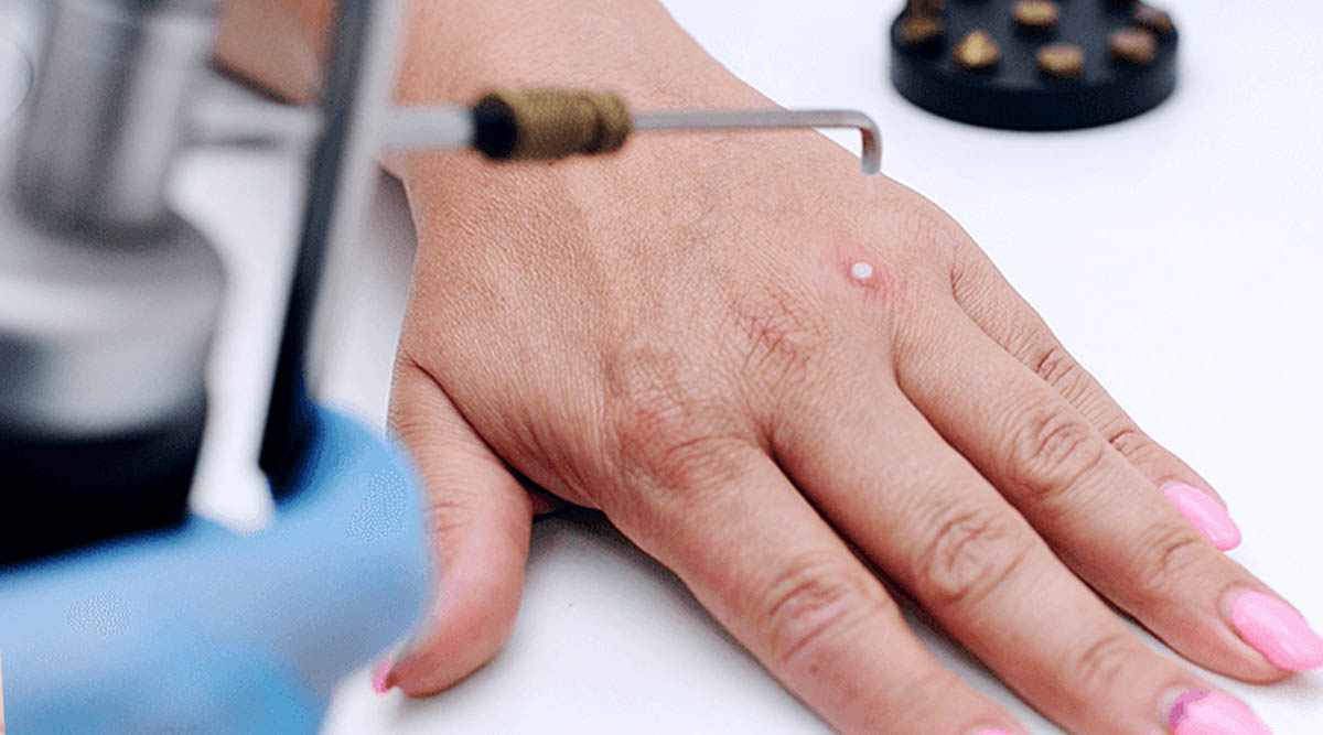 Keloid Freezing Therapy