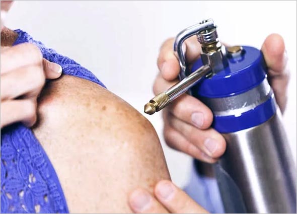 Keloid Freezing Therapy