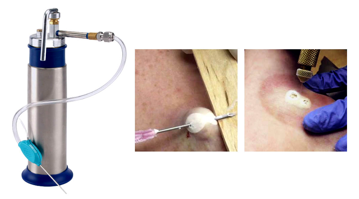 Keloid Freezing Therapy