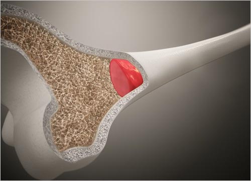 MESENCHYMAL CELL THERAPY 