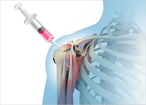 MESENCHYMAL CELL THERAPY