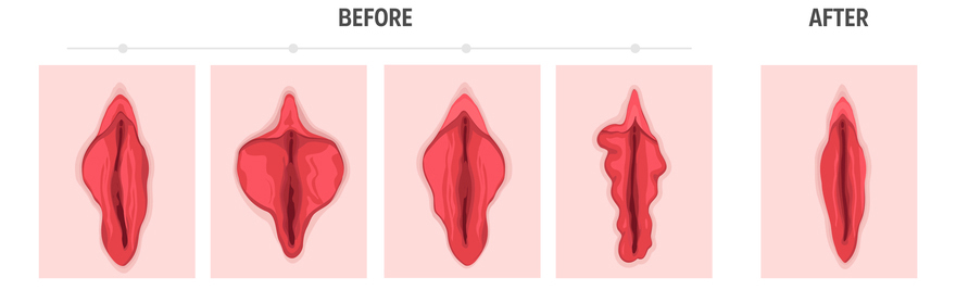 Vulva Filler 