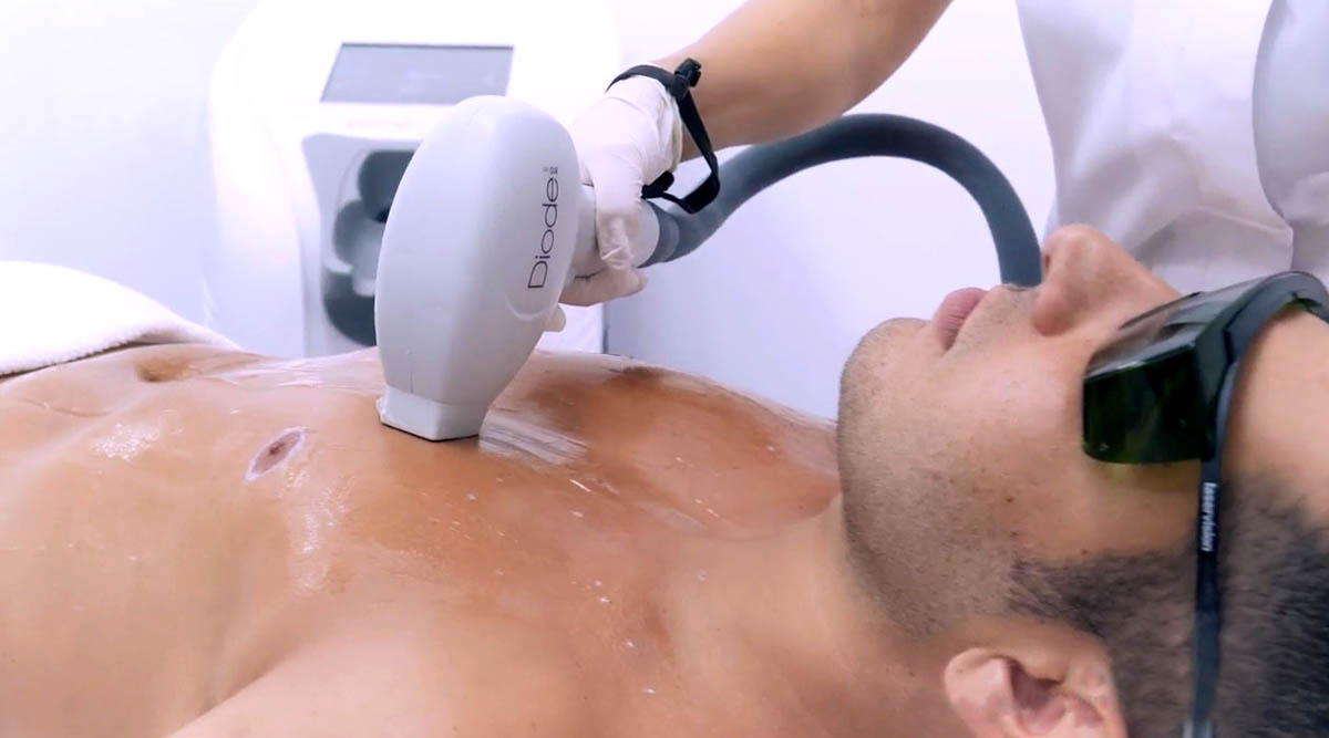 DIODE LASER FOR HAIR REMOVAL