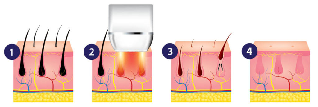 DIODE LASER FOR HAIR REMOVAL