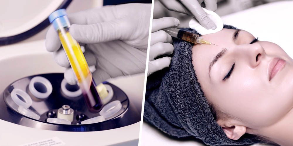 Face PRP Injection