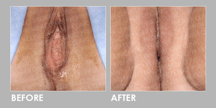 VULVA FILLER Before & After