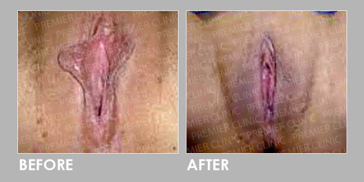 VULVA FILLER Before & After