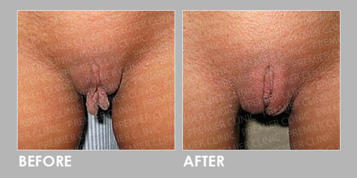 VULVA FILLER Before & After