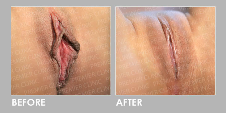 VULVA FILLER Before & After