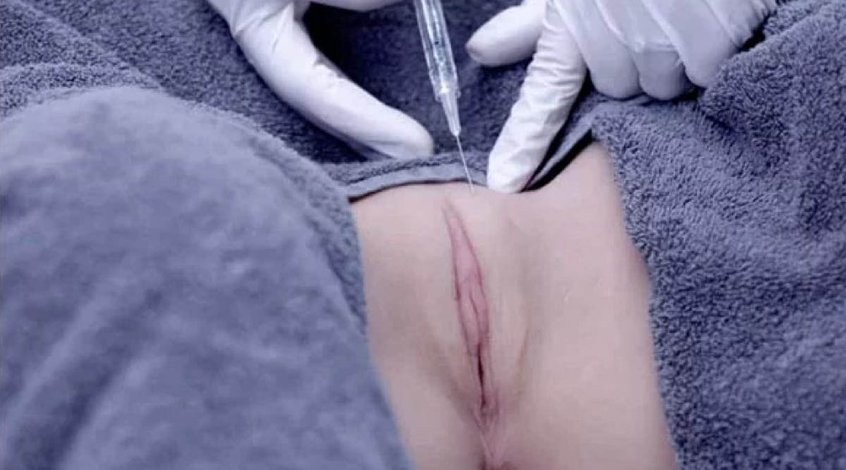 Vulva Filler 
