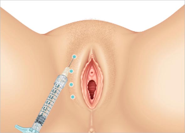 Vulva Filler 