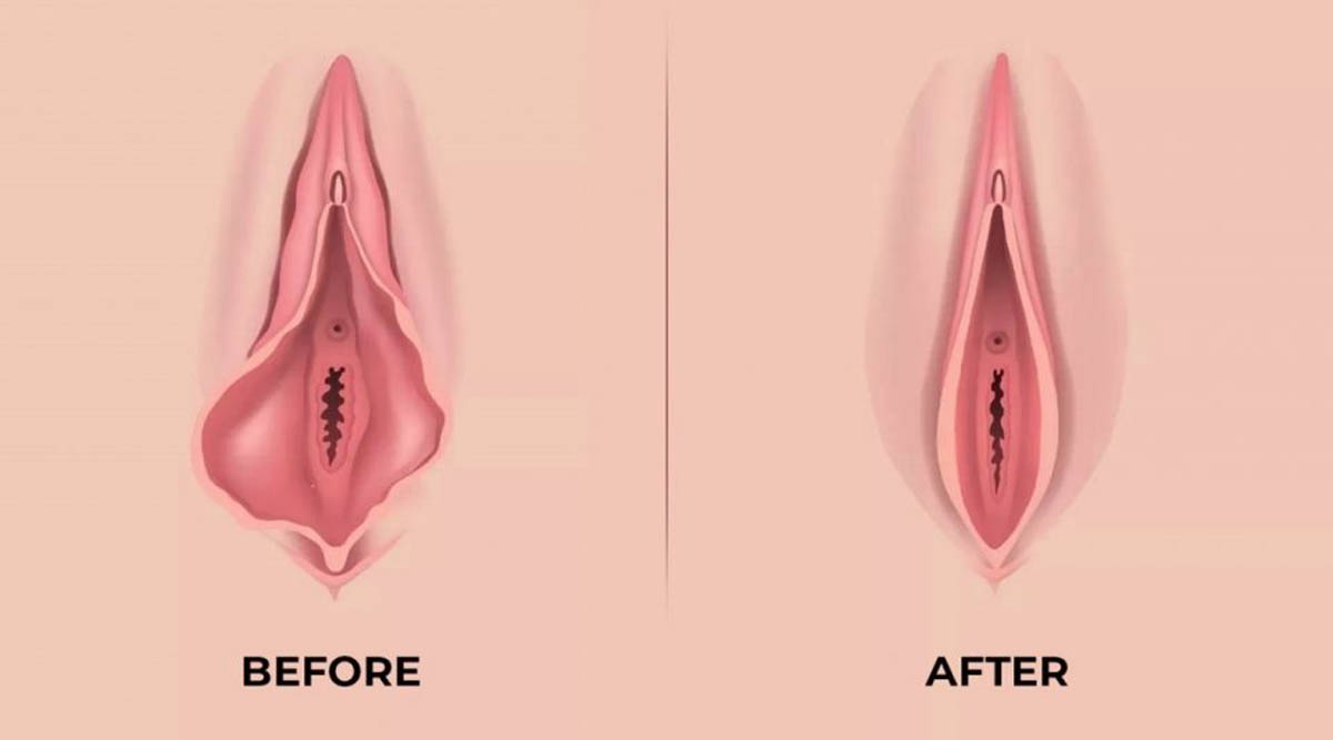 Vulva Filler 