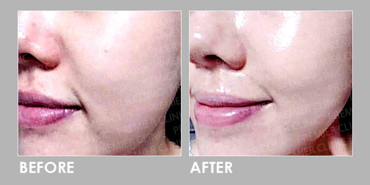 Best Skin Boosters Profhilo & Gouri Promo before and after 02