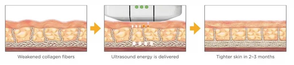 Ultherapy HIFU Treatment