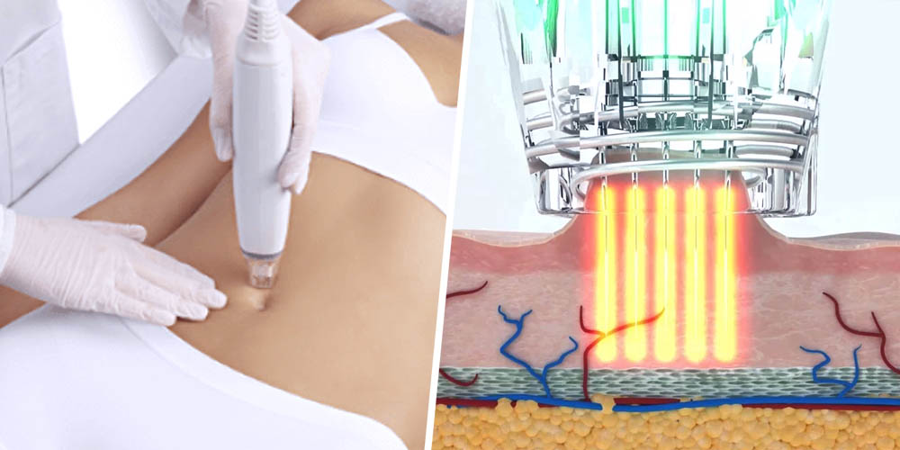 Potenza RF Microneedling