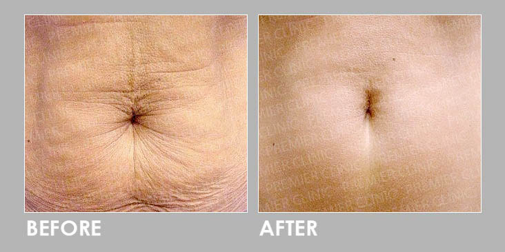 Ultherapy Potenza Skin Lift Promo before and after