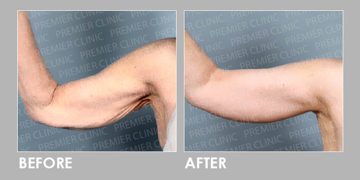 Ultherapy Potenza Skin Lift Promo before and after