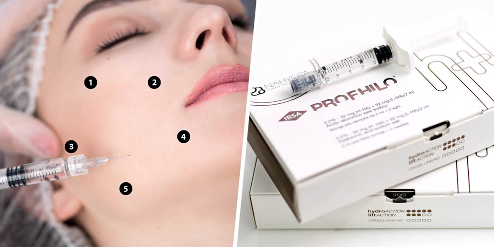 profhilo injection