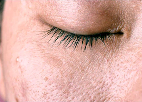 Dehydrated Skin