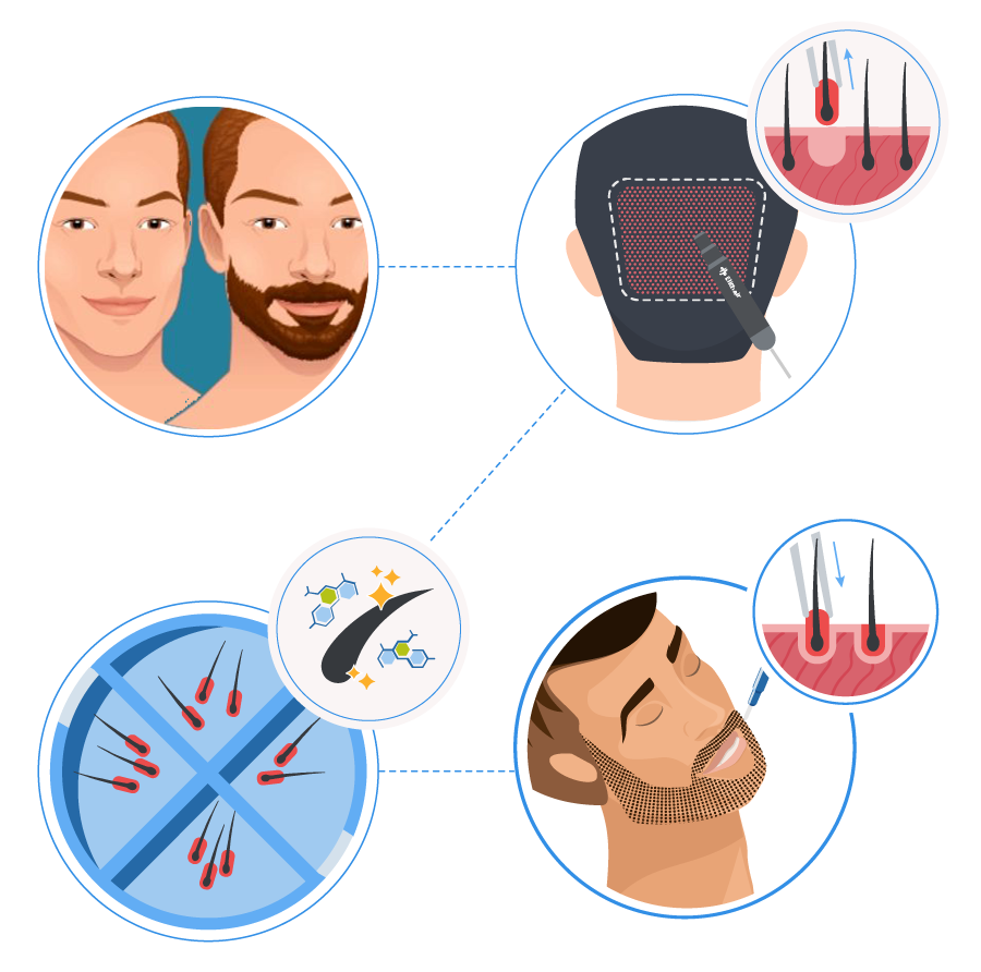 FUE Beard Hair Transplant in Premier Clinic