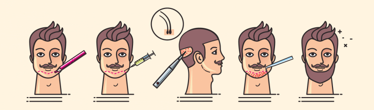 FUE Beard Hair Transplant in Premier Clinic