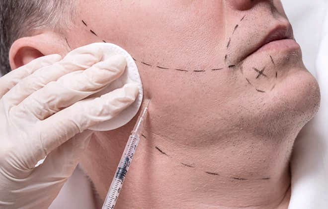 FUE Beard Hair Transplant - Local Anaesthesia 