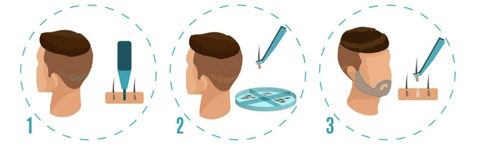 FUE Beard Hair Transplant in Premier Clinic