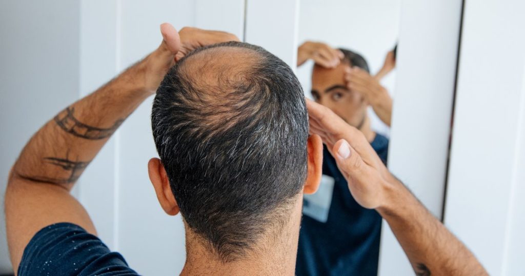 HAIR LOSS TREATMENTS?