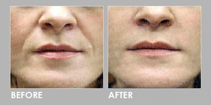 AestheFill Before & After