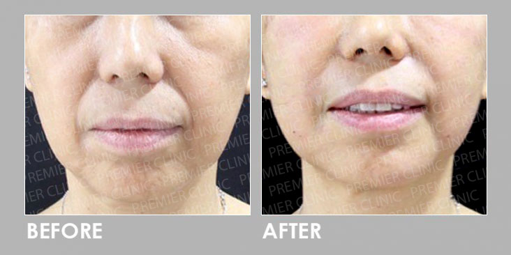 AestheFill Before & After