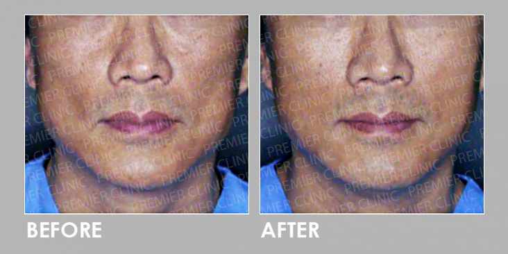 AestheFill Before & After
