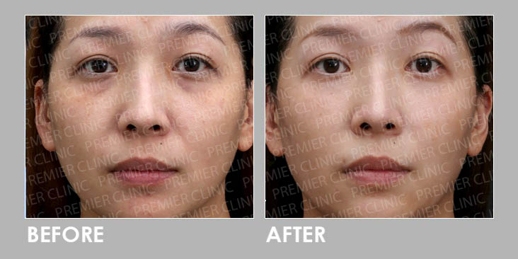 AestheFill Before & After