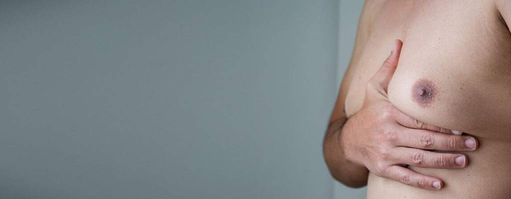 CAUSES OF GYNAECOMASTIA