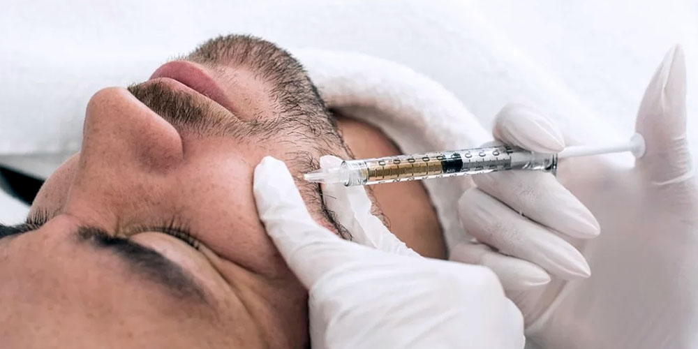 FUE BEARD TRANSPLANT