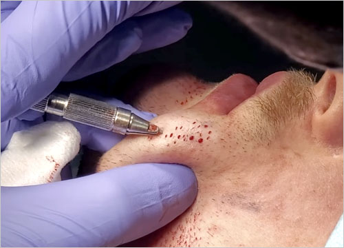 FUE BEARD TRANSPLANT