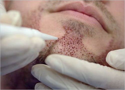 FUE BEARD TRANSPLANT