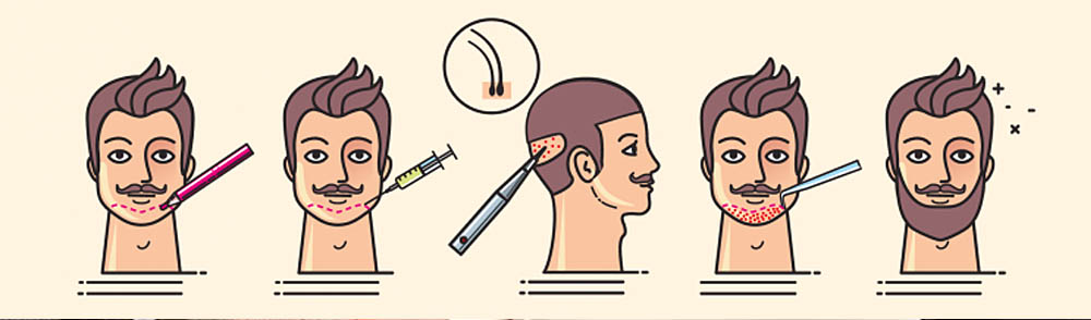 FUE BEARD TRANSPLANT 