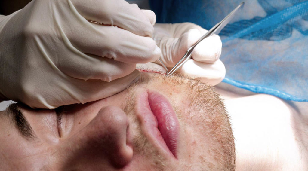 FUE BEARD TRANSPLANT
