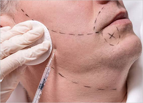 FUE BEARD TRANSPLANT