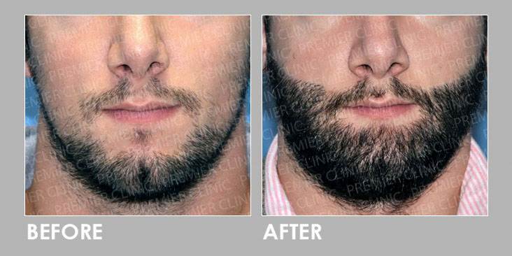 FUE BEARD TRANSPLANT before & after